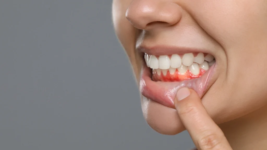 Brushing Teeth but Gums Still Inflamed