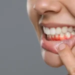 Brushing Teeth but Gums Still Inflamed