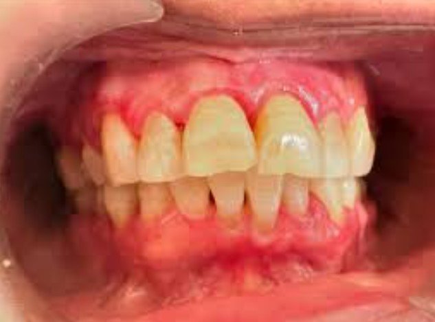 You Experience Gum Peeling or Tissue Sloughing