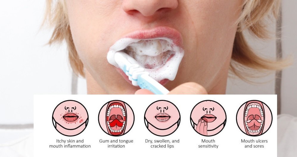 Why Toothpaste Can Irritate the Gums