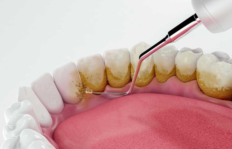 Biofilm Removers for Teeth and Gums