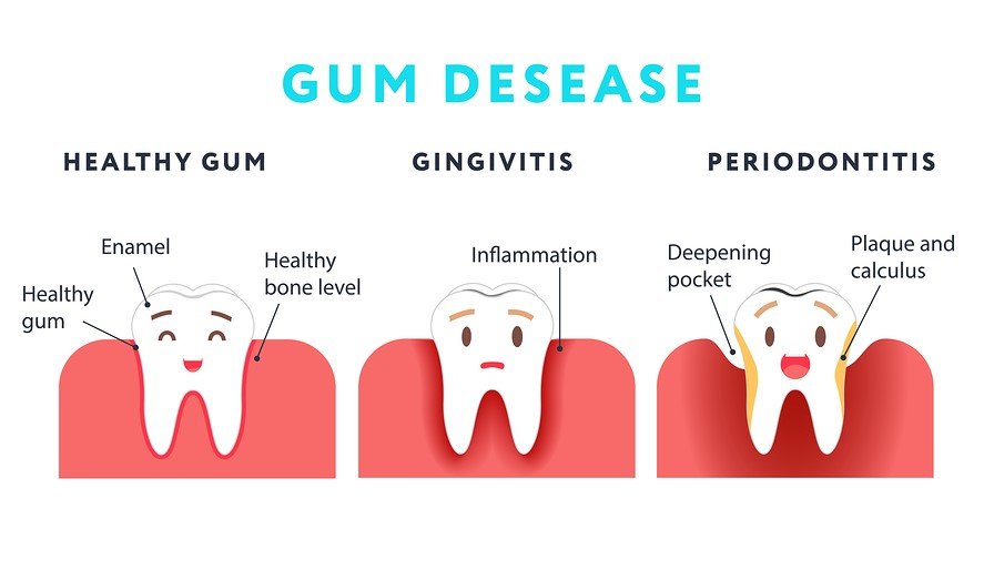 Gum Disease and poor sleep connection