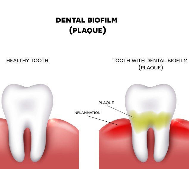 Why Biofilm Matters for Teeth and Gums