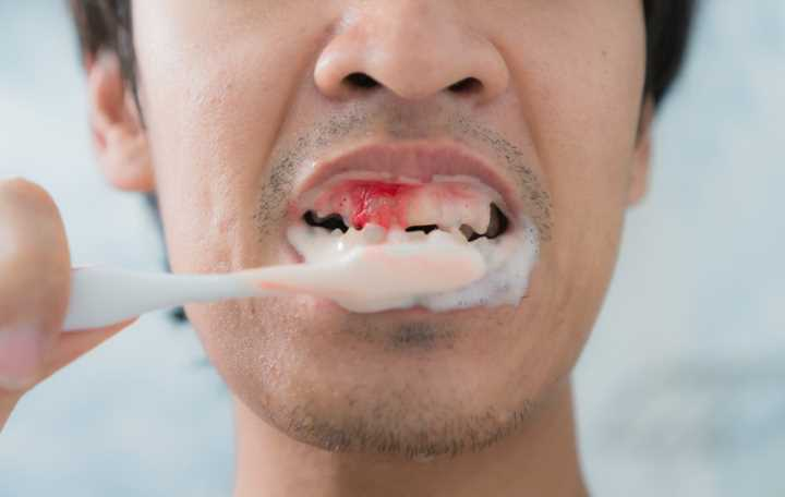 Bleeding Gums Causes