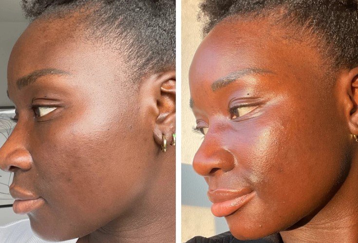 Microneedling for Darker Skin Tones