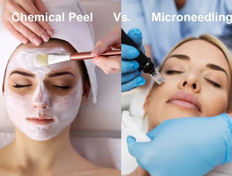 Microneedling vs. Chemical Peels in Lake Mary