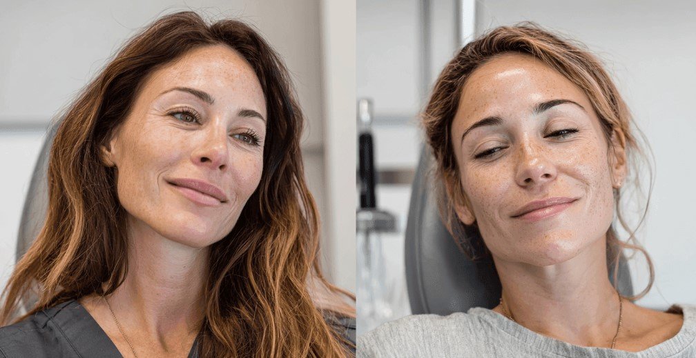 Professional microneedling in Lake Mary