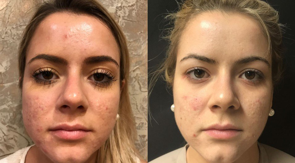 microneedling for Acne Scars Lake Mary